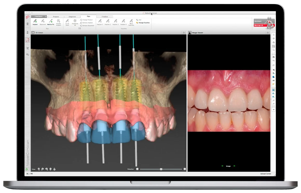 Software de planejamento digital de implante com cirurgia guiada na WIT Odontologia