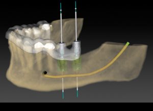 implante dentário em Uberlândia/MG