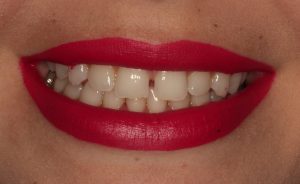 lente de contato dental