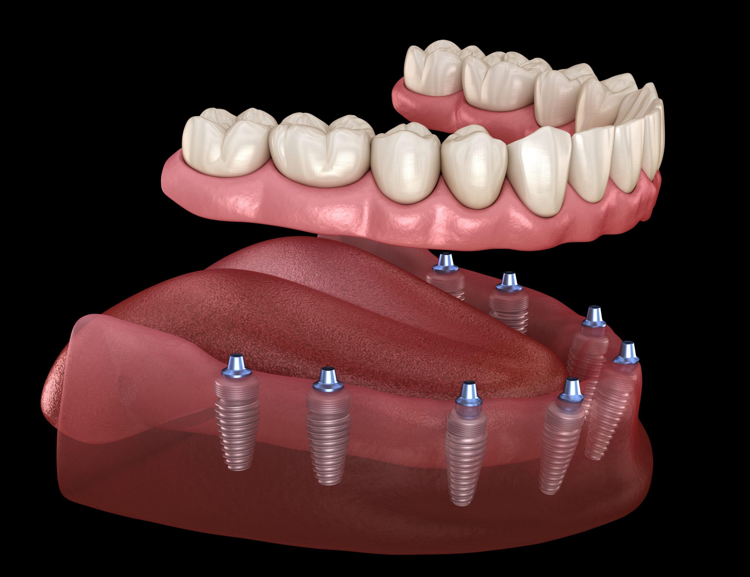 protese total dentaria computadorizada